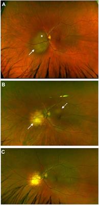 Immune Privilege Furnishes a Niche for Latent Infection